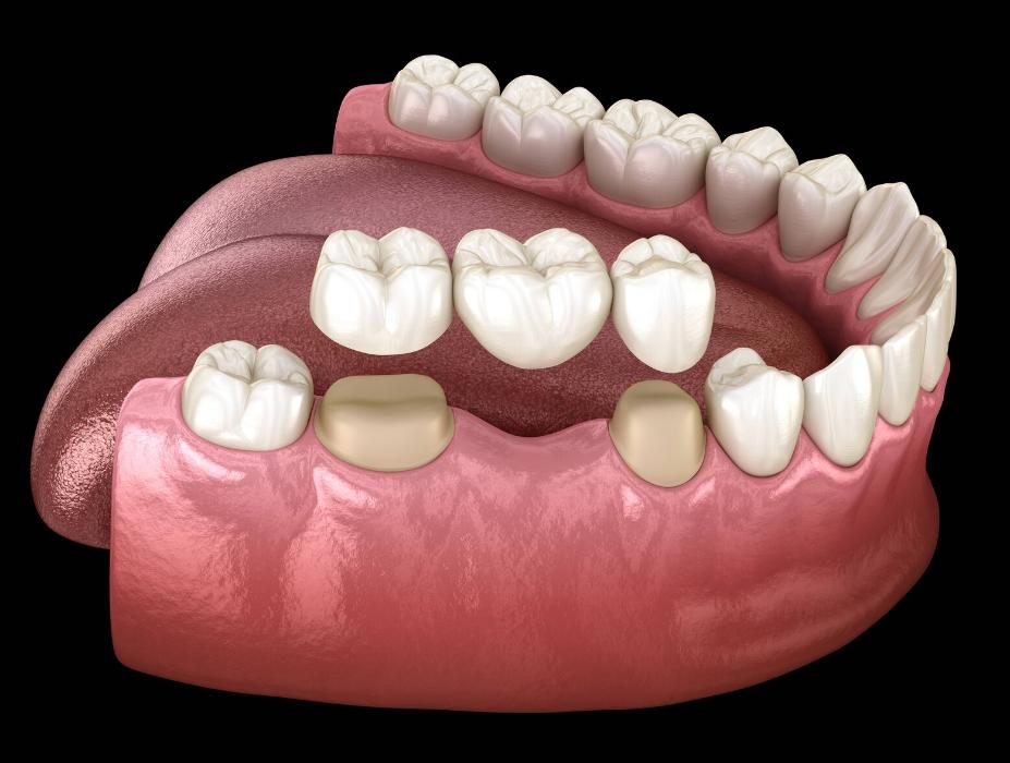 dental bridge in randolph
