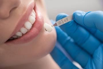 woman getting porcelain dental veneers