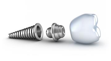dental implant with crown