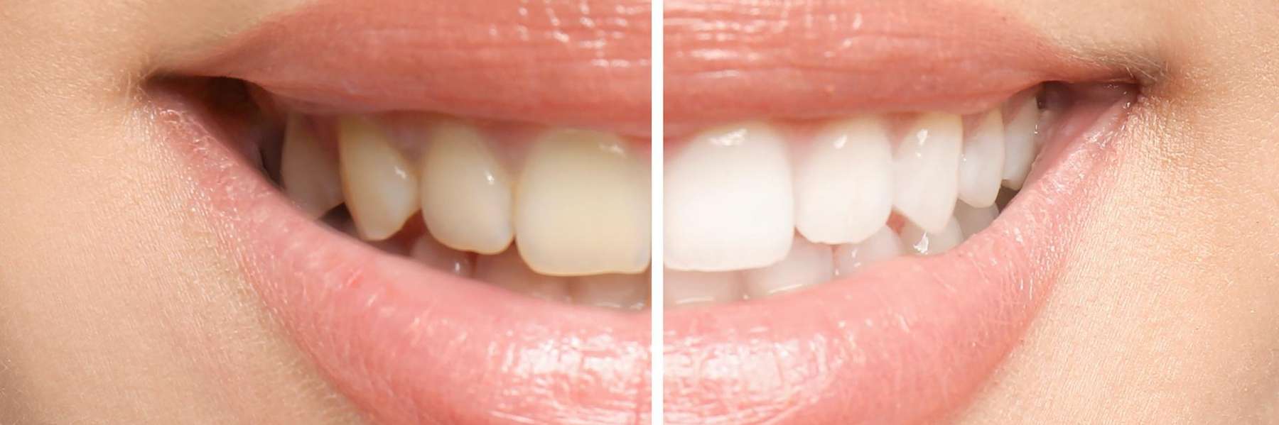 A before and after image of a Cosmetic Dentistry in Randolph, NJ