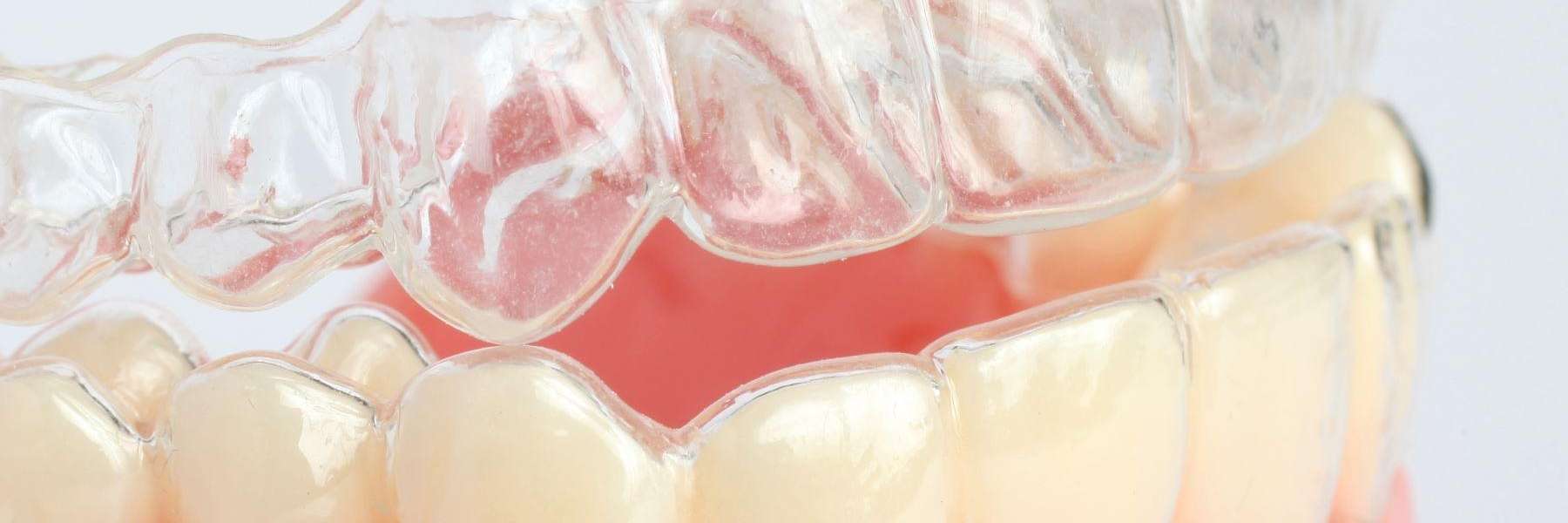 An picture of Invisalign clear aligners in NJ