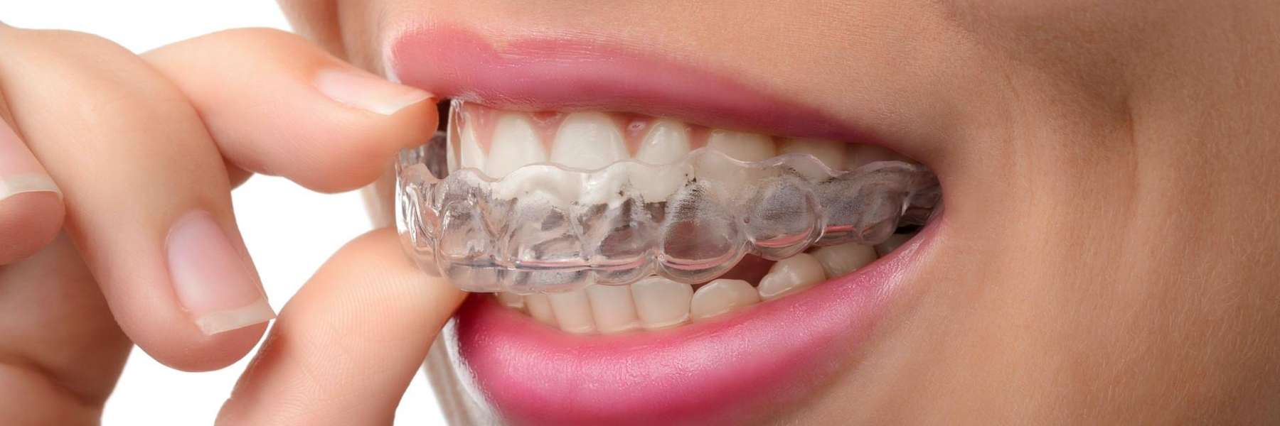 Patient putting Invisalign clear aligners on her teeth at Randolph Dental Associates