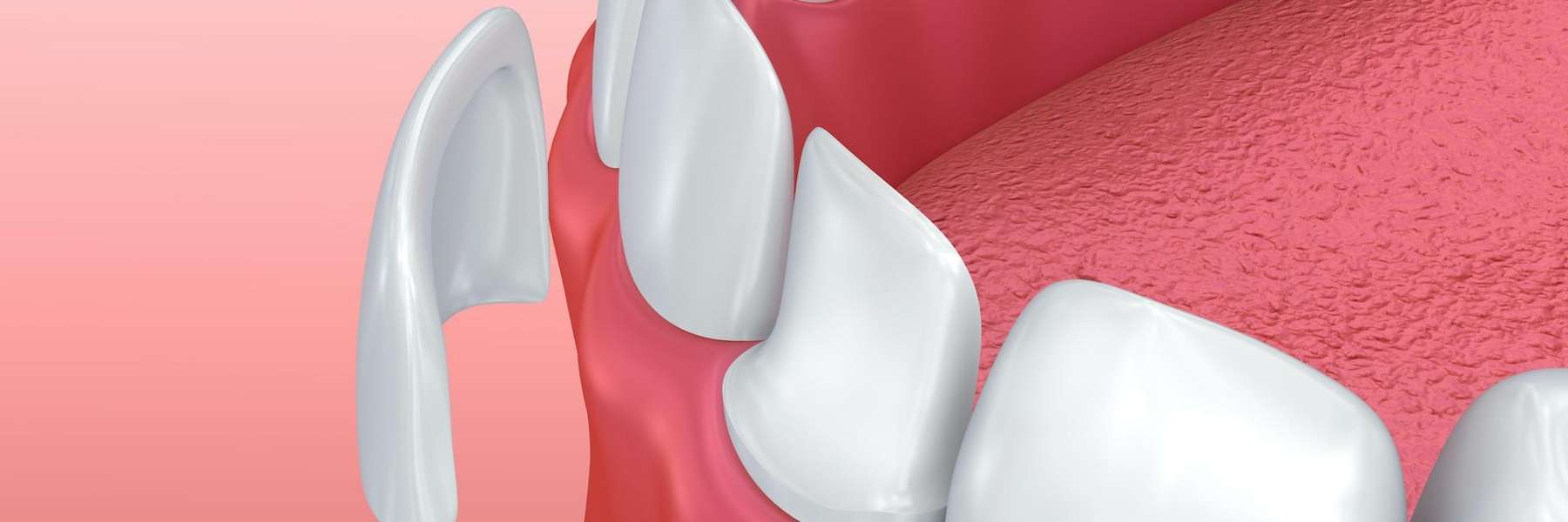 An illustration of a dental veener in in Randolph, NJ