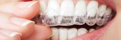 Invisalign Clear Aligners in Randolph, NJ