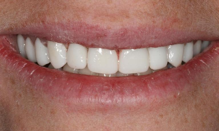 Cosmetic-Restoration-with-Crowns-Veneers-After-Image