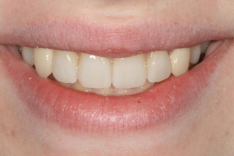 Aesthetic-Restoration-Using-Crowns-Veneers-After-Image