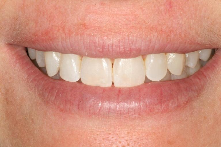 Straight-smile-with-Invisalign-After-Image