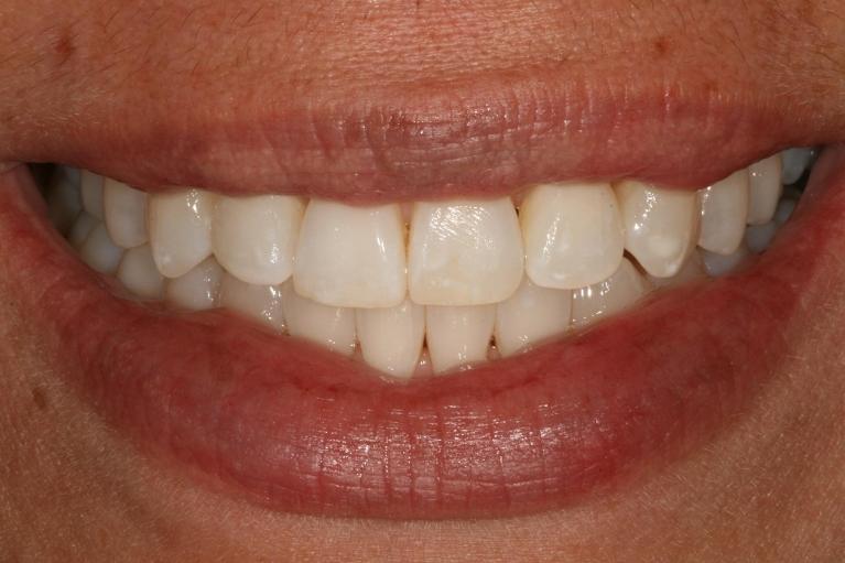 Invisalign-Subtle-Shift-Big-Impact-After-Image