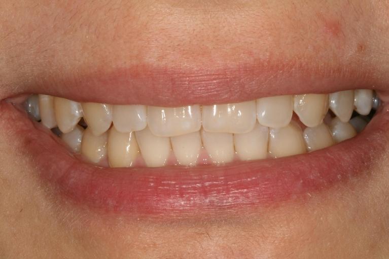 invisalign closed this patient's space between their front teeth