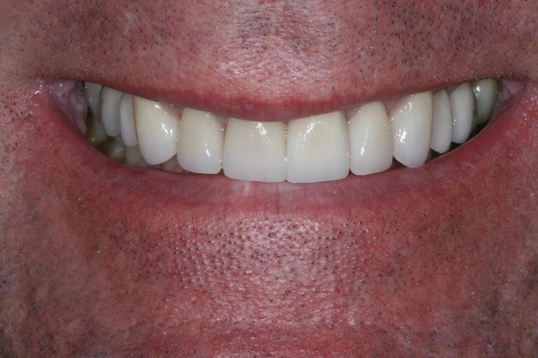 Combination-of-Crowns-Veneers-After-Image