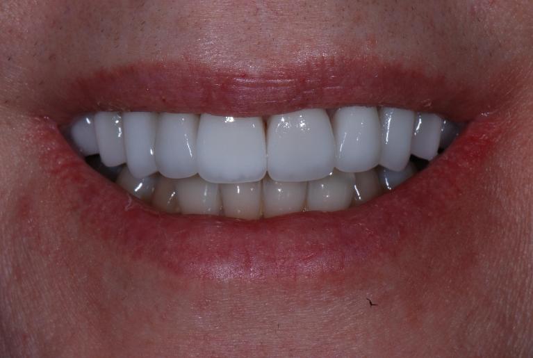 Dental-Veneers-After-Image