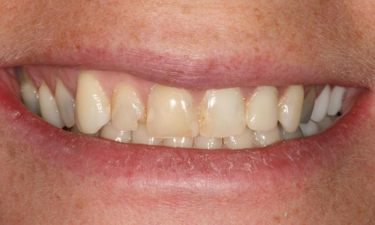 Cosmetic-Restoration-with-Crowns-Veneers-Before-Image