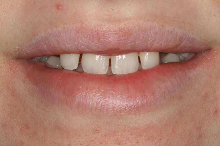 Aesthetic-Restoration-Using-Crowns-Veneers-Before-Image