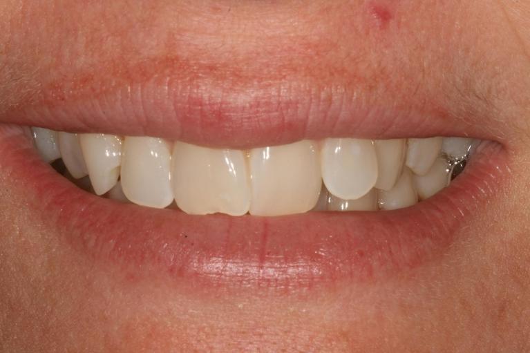 Straight-smile-with-Invisalign-Before-Image