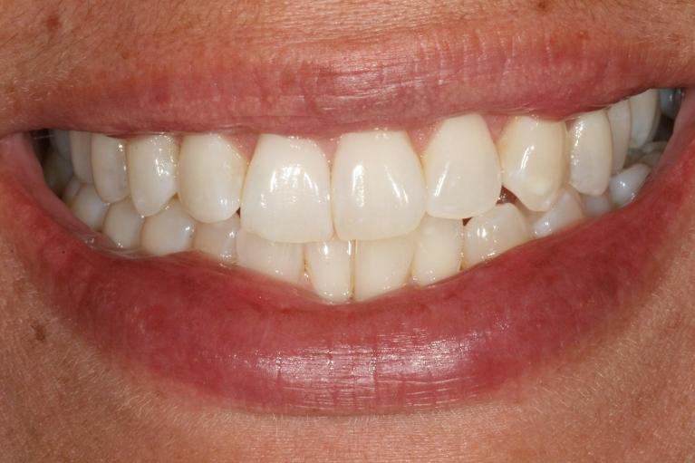 Invisalign-Subtle-Shift-Big-Impact-Before-Image