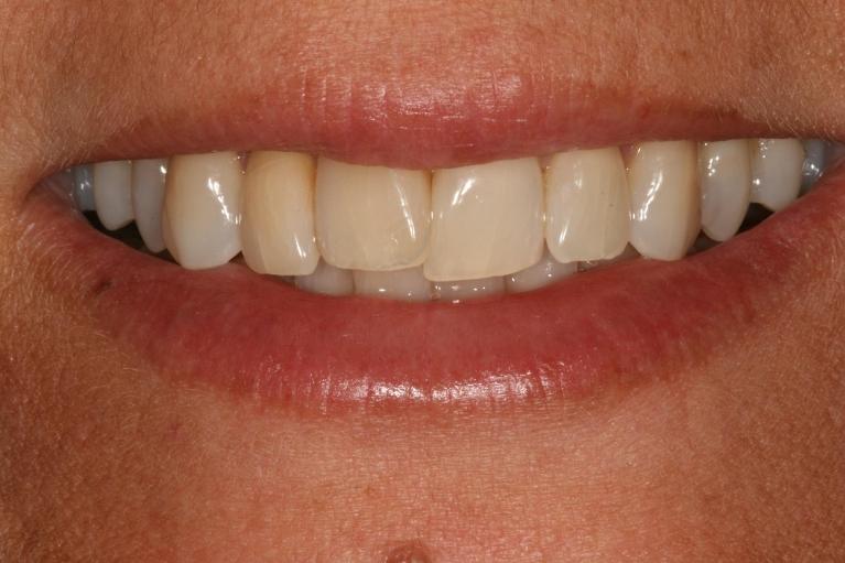 misaligned front teeth