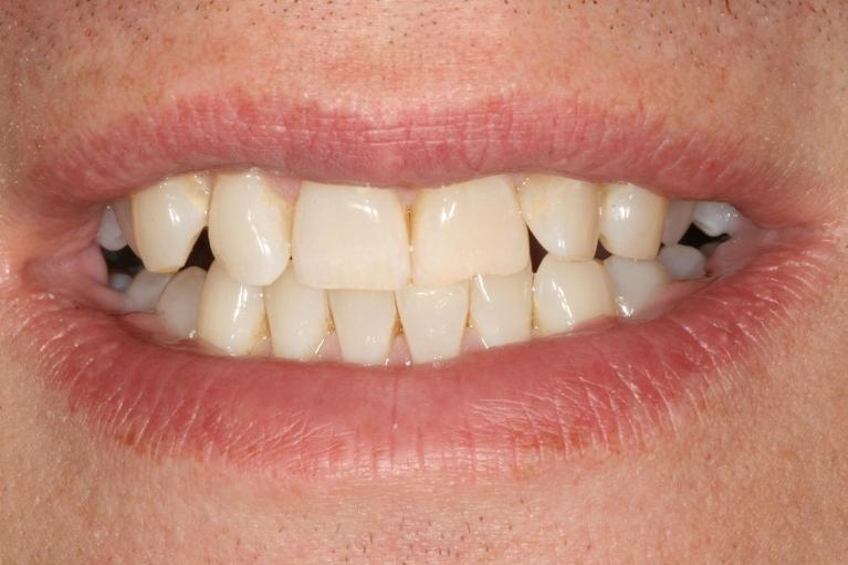patient's smile with crooked teeth