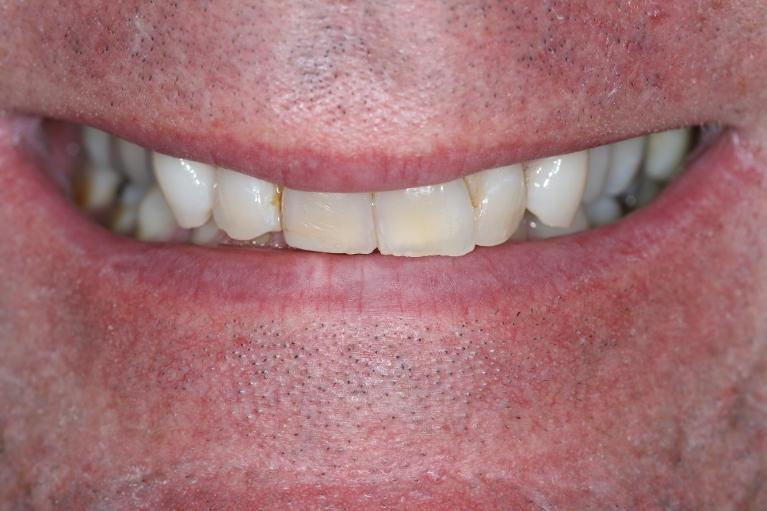 Combination-of-Crowns-Veneers-Before-Image