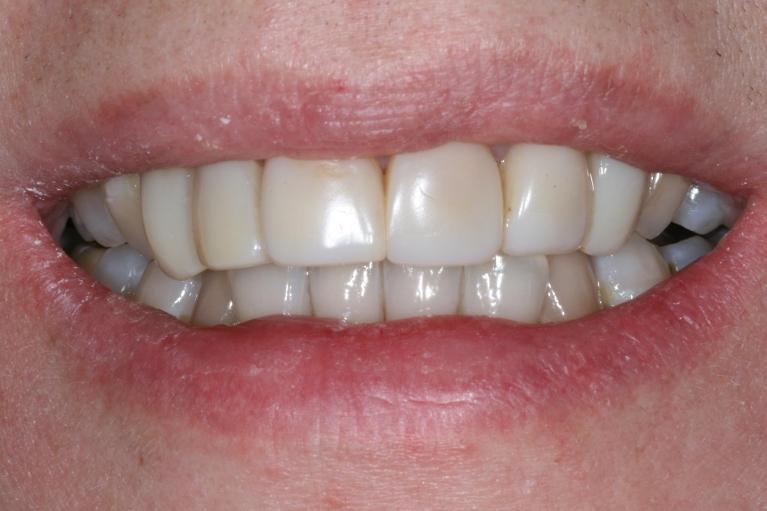 Dental-Veneers-Before-Image
